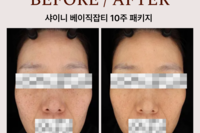 색소패키지(베이직잡티 패키지) 시술 전후