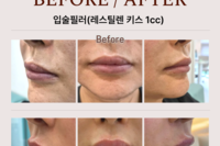 입술필러(레스틸렌 1cc)후기
