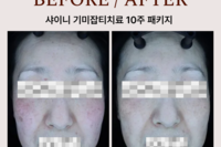 색소패키지(기미잡티 패키지) 시술 전후