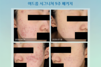 여드름 패키지 전후사진
