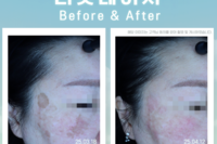 리팟레이저 시술 전후(Before & After)
