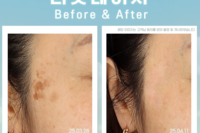 리팟레이저 시술 전후(Before & After)