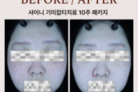 색소패키지(기미잡티 패키지) 시술 전후