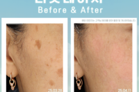 리팟레이저 시술 전후(Before & After)