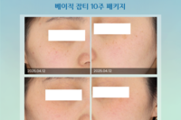 기미/잡티 색소치료